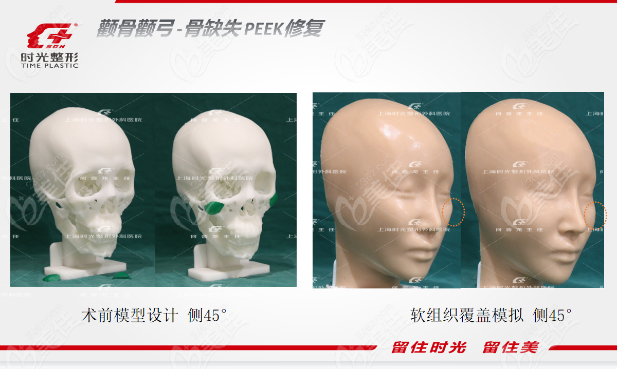 何晋龙颧骨修复价格