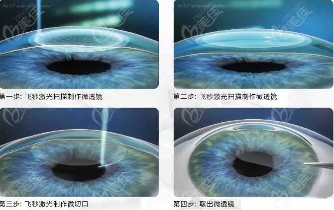 许昌眼科医院这全飞秒价格不算贵www.236z.com