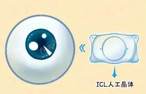 深圳佰视佳眼科icl晶体植入手术价格表