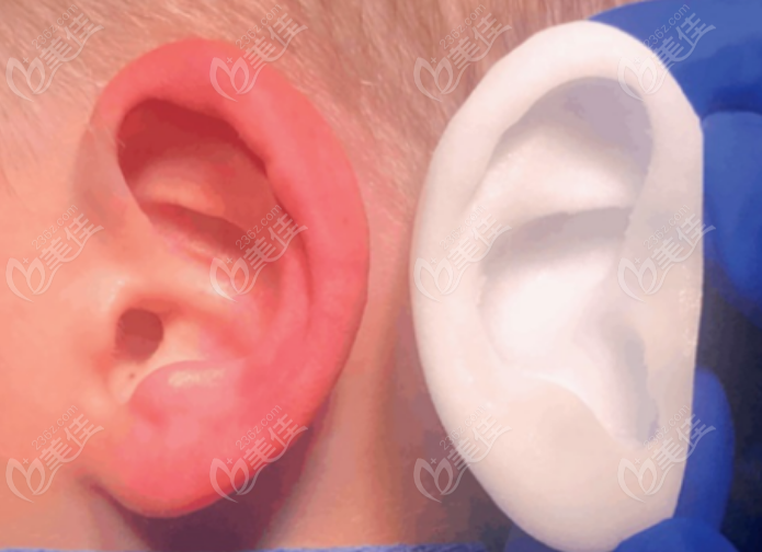 耳再造舒铂和曼特波优缺点区别