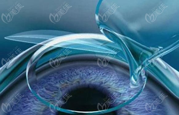 龙岩华厦眼科医院icl晶体植入近视眼手术价格