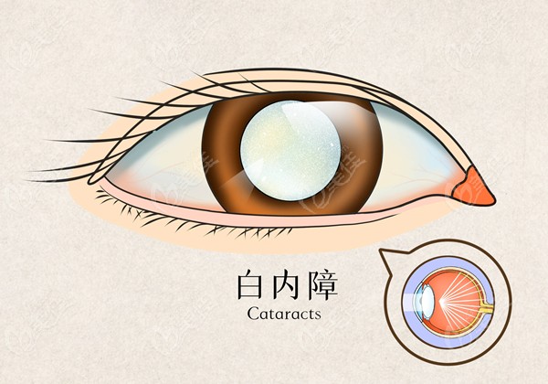 何氏眼科白内障手术费用大概多少钱