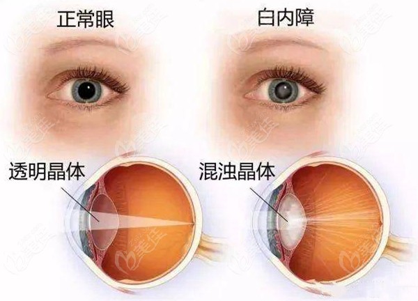 何氏眼科白内障手术治疗价格表