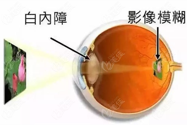 白内障眼睛成像