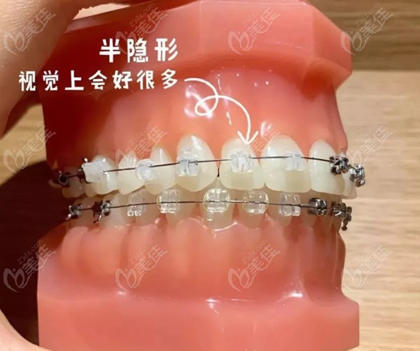 阳春口腔医院牙齿矫正价格：8000-40000元左右