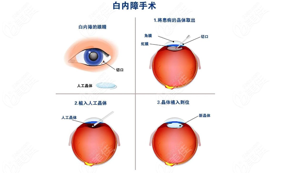 白内障手术