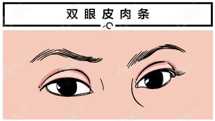 张悦迪双眼皮修复实例236z.com