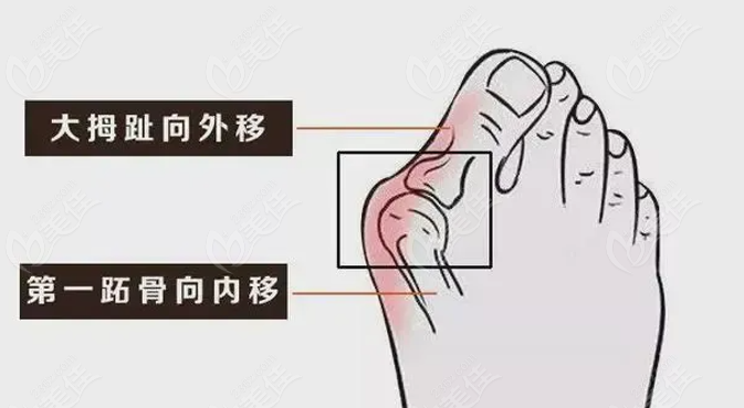 海虹桥医院拇外翻专科技术好