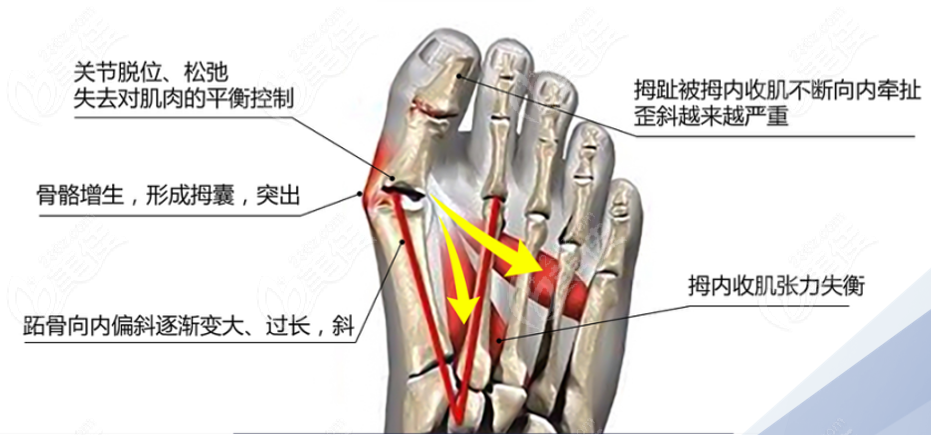 北京圣嘉新脚拇指外翻矫正技术好