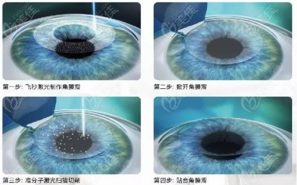 深圳佰视佳眼科半飞秒手术做的好