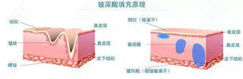馨妍玻尿酸和艾莉薇玻尿酸的对比有哪些