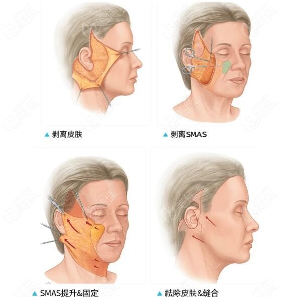 拉皮手术去法令纹可靠吗m236zcom