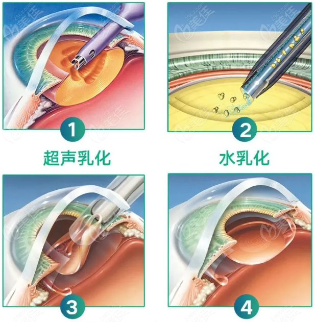 白内障超声乳化人工晶体植入手术236z.com