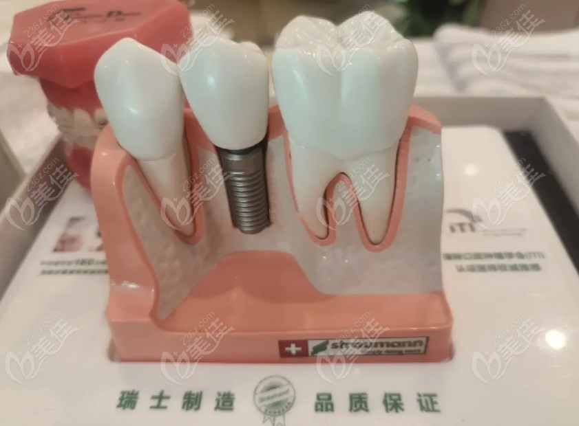 种植牙模型示意图