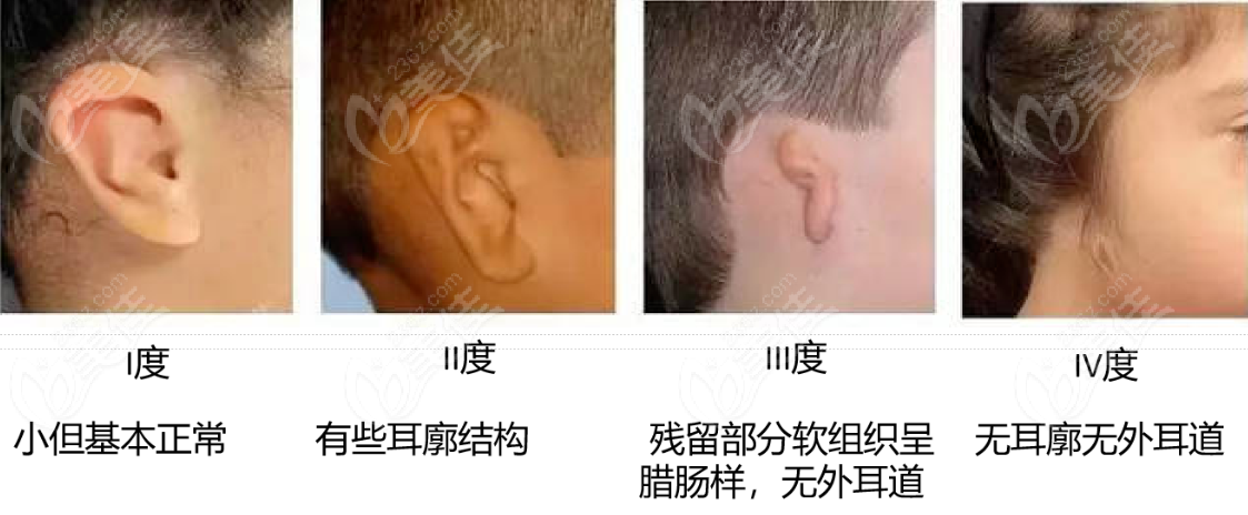 耳再造手术类型