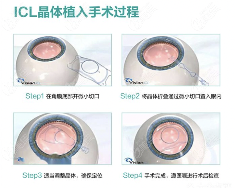 上海爱尔眼科医院晶体植入价格