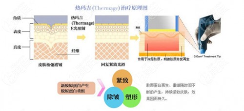 热玛吉全脸除皱手术原理