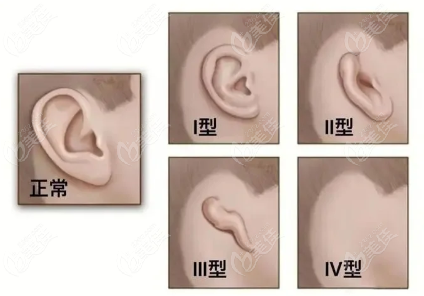 一只直埋法耳再造手術(shù)價(jià)格450000元起
