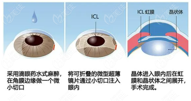 毛凯波眼科医生晶体植入手术过程