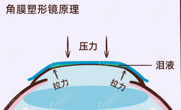 爱尔眼科角膜塑形镜价格表：4800元起一副