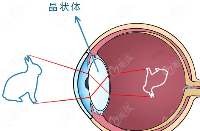 白内障晶体植入近视，远视矫正功效不同