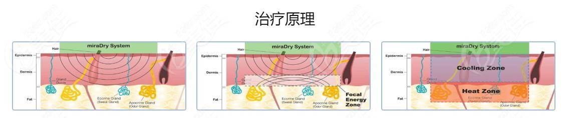 miraDry微波治疗腋臭原理