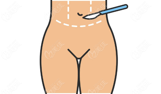 <!--<i data=20240703-sp></i>-->腹壁整形手术做得好的医生有谁呢