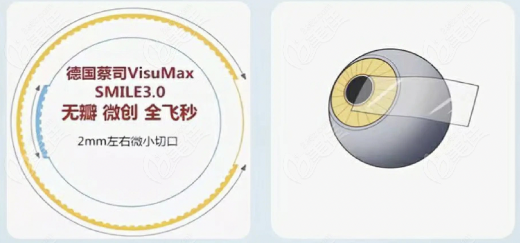武汉爱尔眼科医院收费价目表-美佳