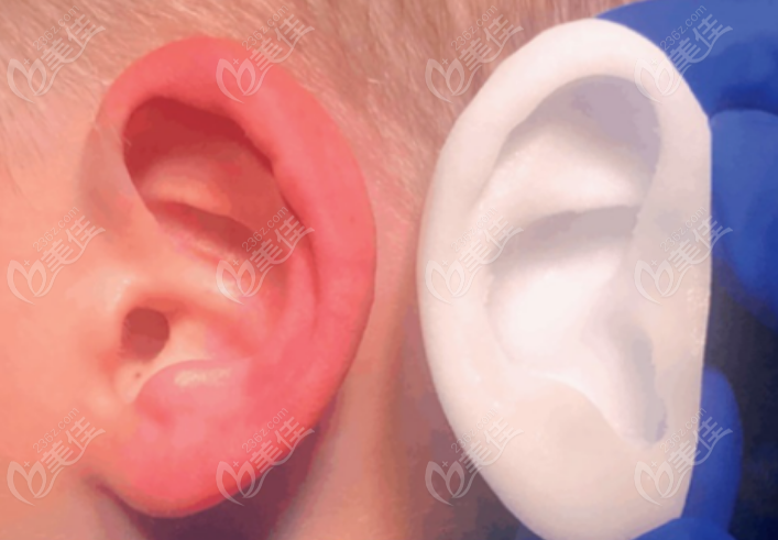 生物支架耳再造手术与真耳相似度高