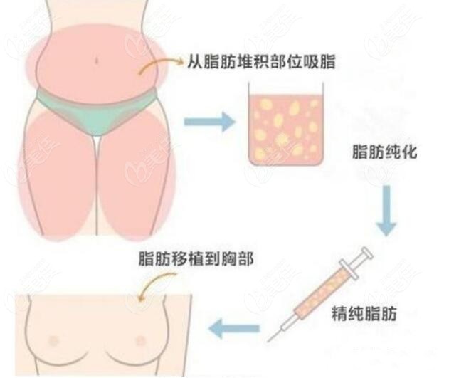 兰州韩美整形脂肪丰胸手术过程