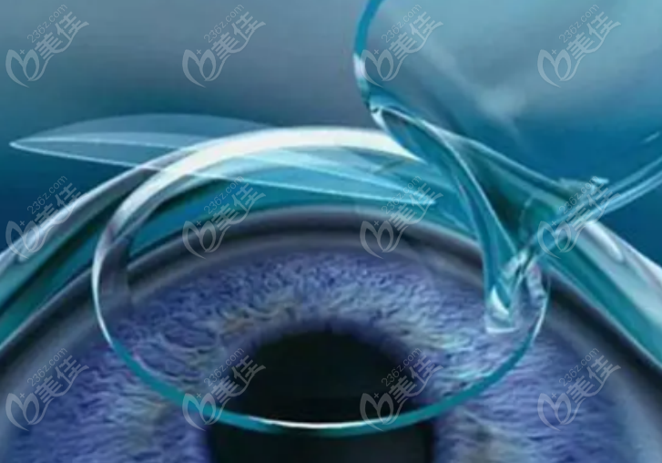 近视手术 近视手术