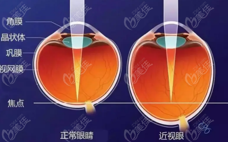 近视手术 近视手术