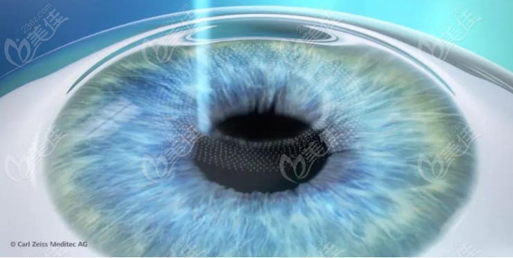近视手术 近视手术