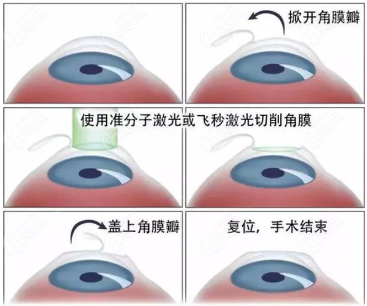 近视手术 近视手术