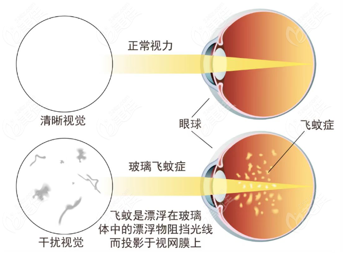 爱尔眼科飞蚊症消融术收费2000-8000起