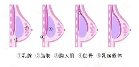 上海隆胸假体取出修复好的医院排名