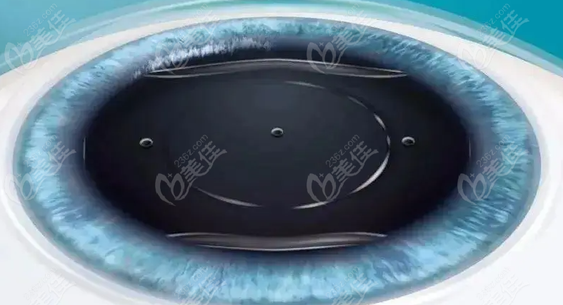西安海翔眼科蒋海翔icl晶体植入手术技术怎么样？