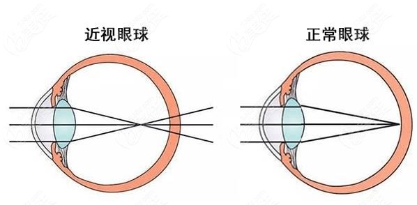 青岛激光近视眼手术价格多少钱