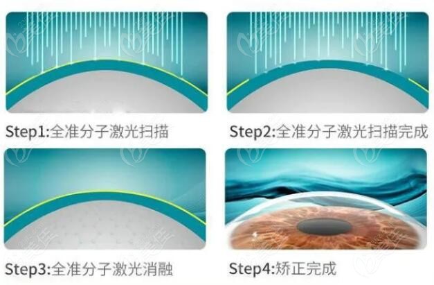 青岛激光近视眼矫正手术收费236z.com
