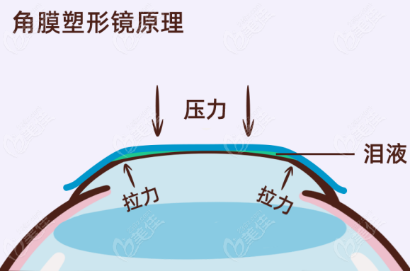 角膜塑形镜控制原理 角膜塑形镜控制原理