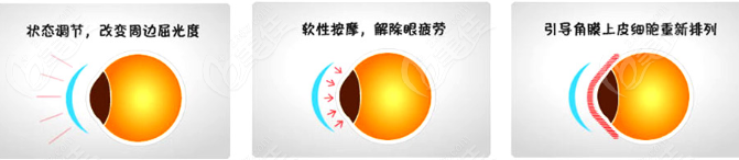 儿童戴角膜塑形镜10年疗效好 儿童戴角膜塑形镜10年疗效好