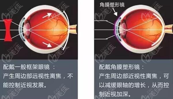 济宁麦迪格眼科角膜塑形镜多少钱236z.com
