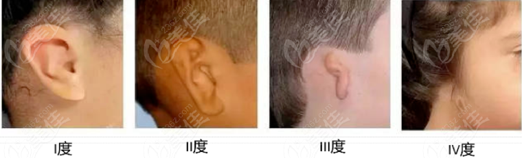 人造耳朵可以改善的耳朵形态