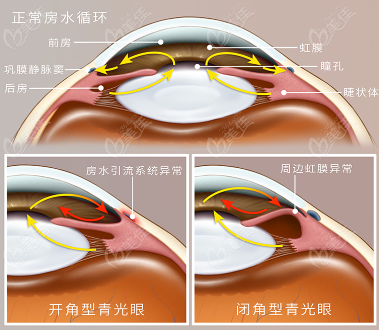 闭角型青光眼和开角型青光眼区别