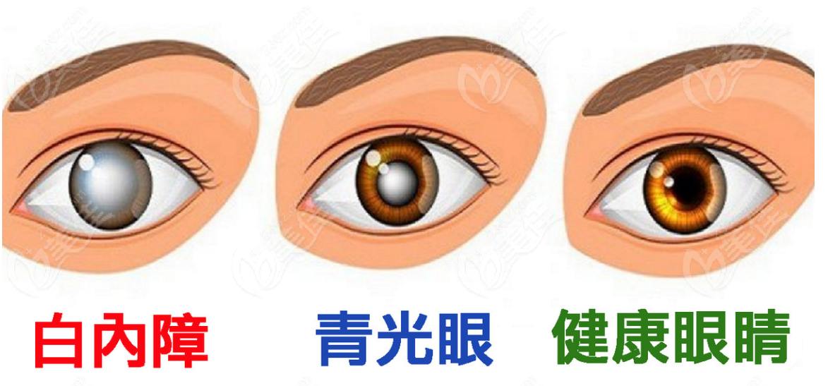 白内障青光眼和正常眼睛区别