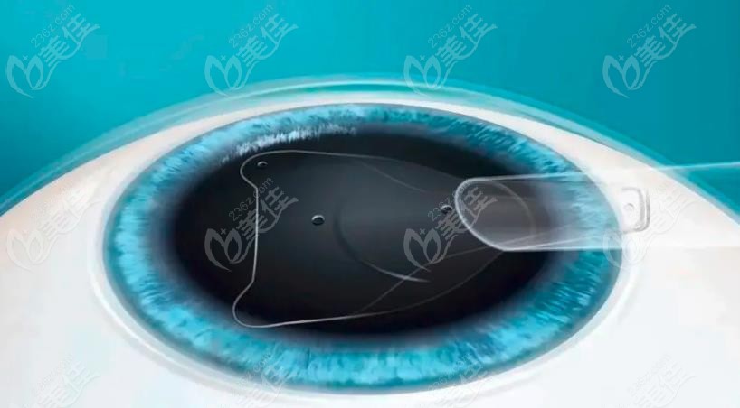 深圳深东爱尔眼科医院TICL带散光晶体植入近视眼手术价格