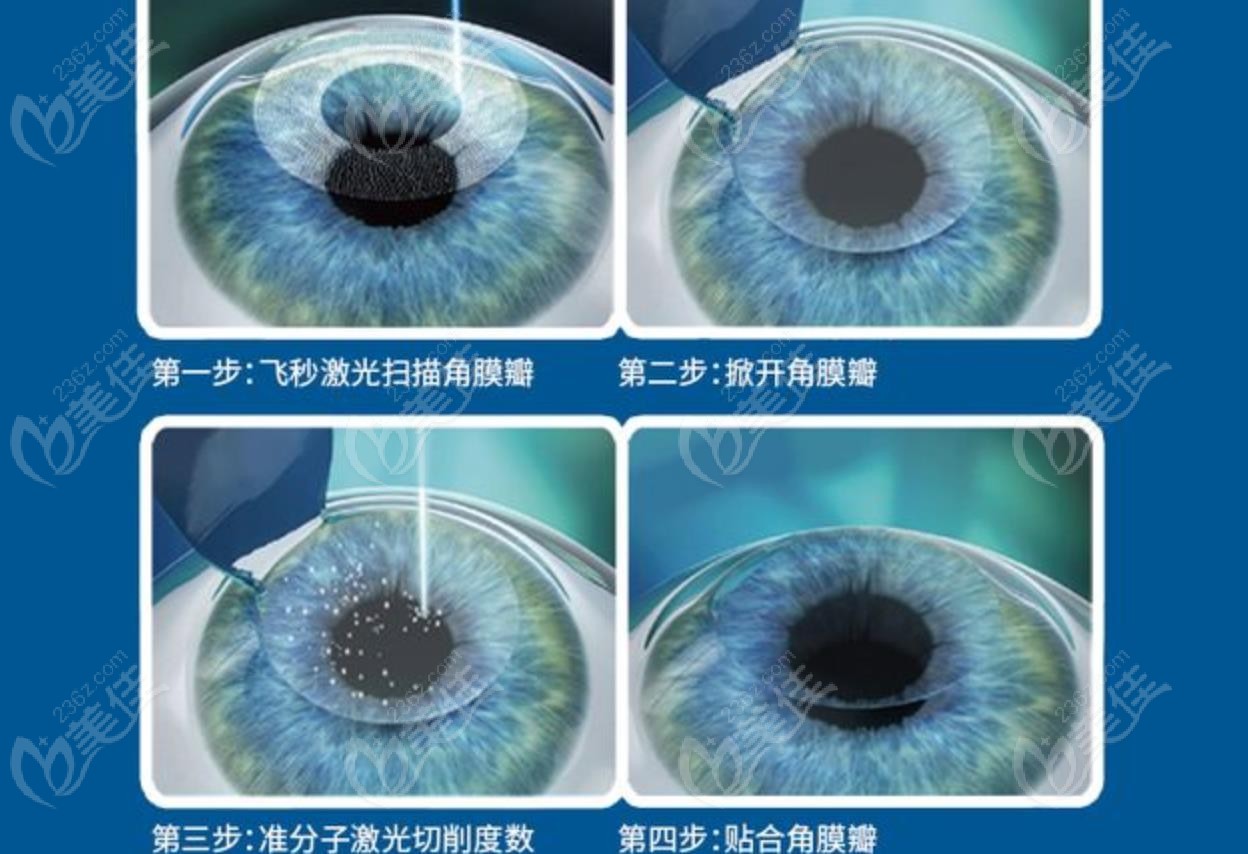 近视手术步骤
