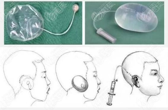做耳再造手术全包法注水会有点疼