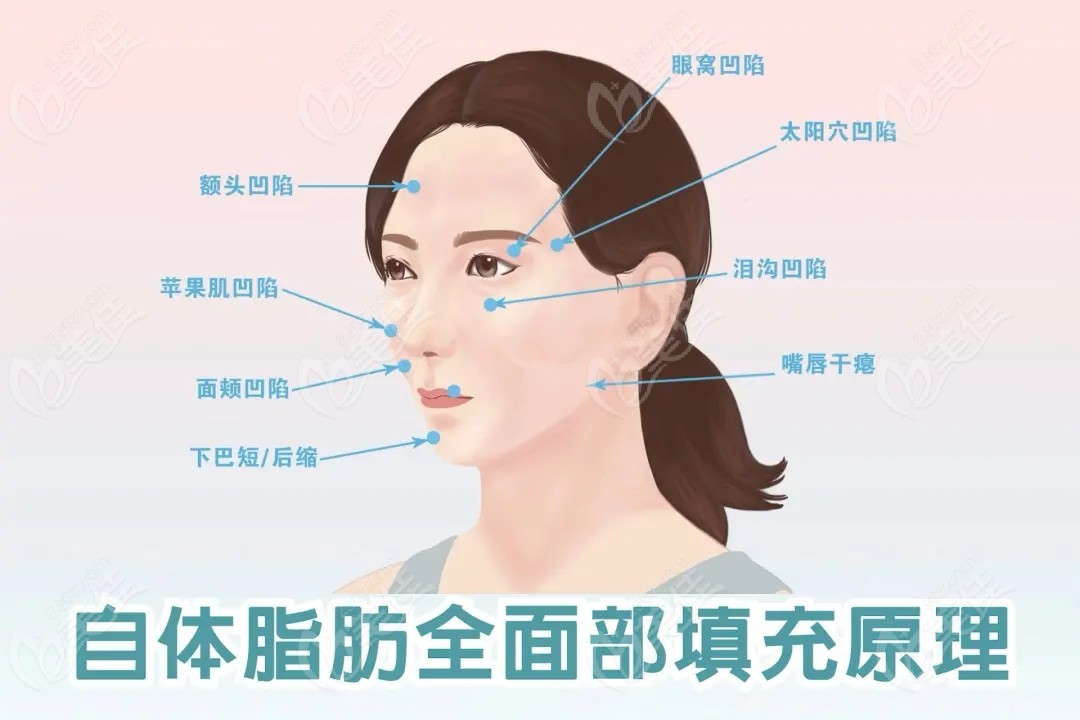 张让虎做脂肪填充好