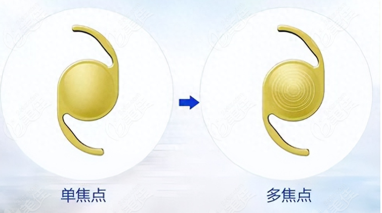 白内障做一只单焦晶体一只多焦晶体会怎么样